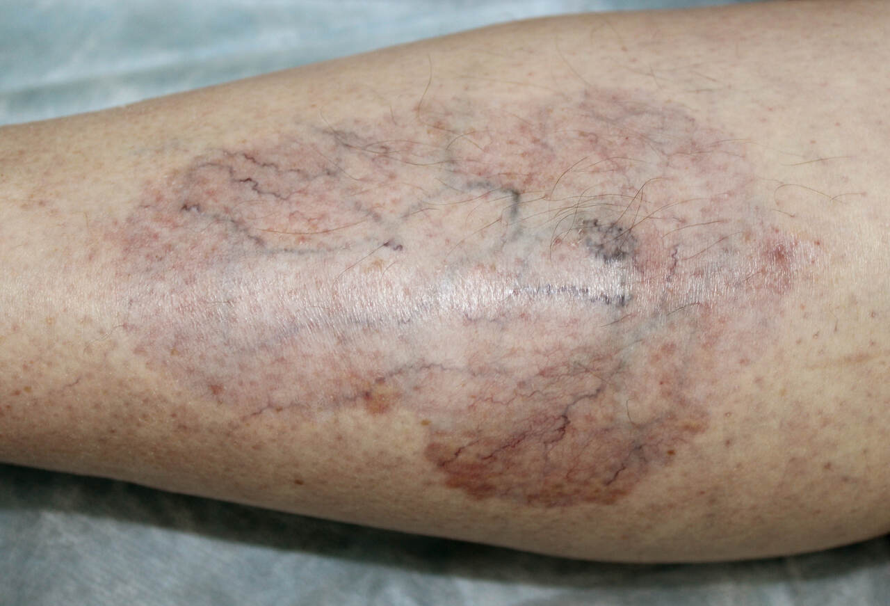 Sinal de diabetes: necrobiose lipoídica